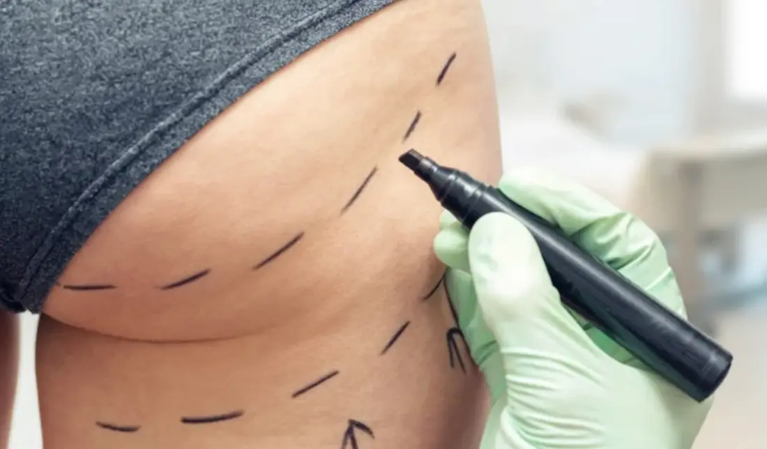 Clinical reference image for Brazilian Butt Lift (Gluteal Fat Grafting) — plastic surgery by Dr. Sanjog Sharma, Dubai and Bengaluru