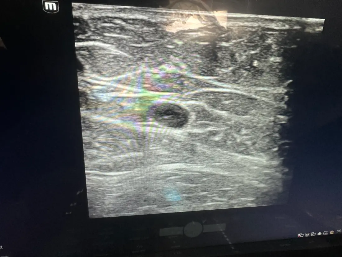 Illustration of subcutaneous fat placement above the gluteal muscle during a Brazilian butt lift